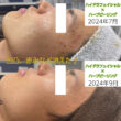 ニキビ跡、凹凸、ざらつき毛穴にお悩みの方必見です☆