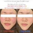赤み、乾燥が気になる方☆是非受けてみてください☺