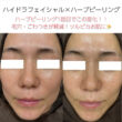 毛穴のお悩みにはハーブピーリングがおすすめです✨