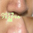 夏本番になる前に必須☆毛穴洗浄のハイドラフェイシャル